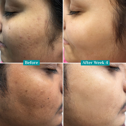 Teashell Niacinamide Brightening Serum Fades Dark Spots, Evens Skin Tone & Boosts Glow (Copy)