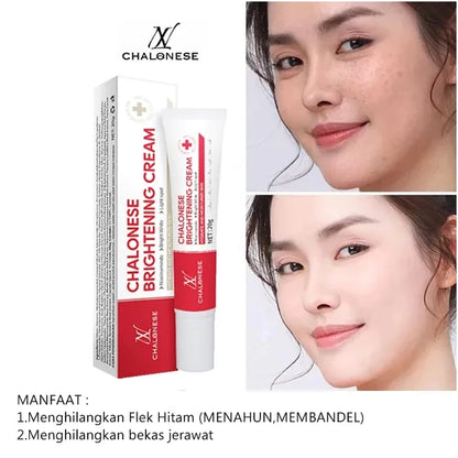 Chalonese Cream | Anti Pigmentation & Acne Cream