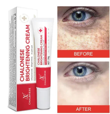 Chalonese Cream | Anti Pigmentation & Acne Cream