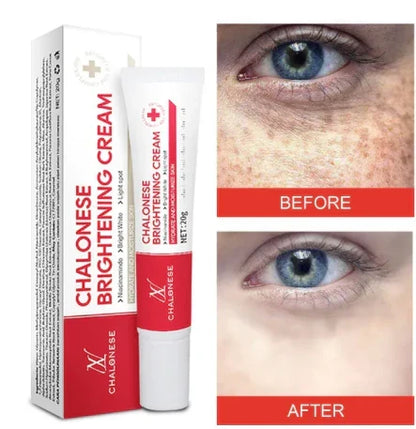 Chalonese Cream | Anti Pigmentation & Acne Cream